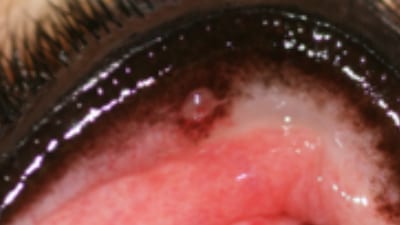 Extra eyelashes fact sheet - Ectopic cilia